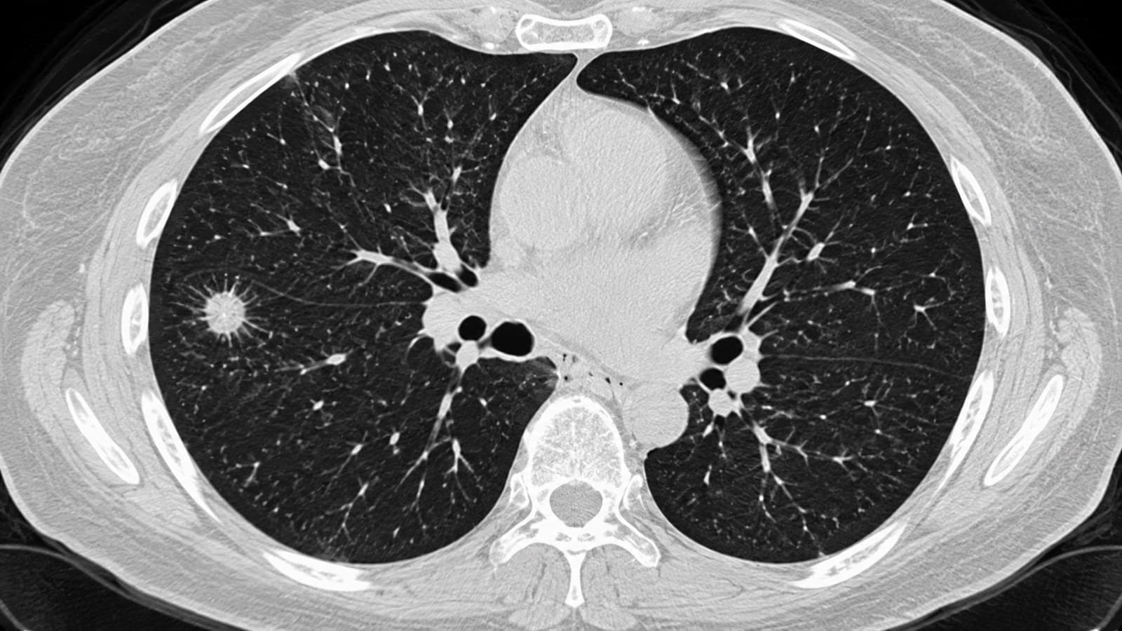 Smoked for Years? You May Qualify for Lung Cancer Screening